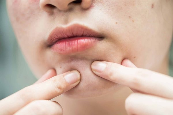 Avez-vous une peau acnéique ? Conseils et astuces pour les produits à utiliser